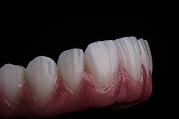 implantes dentários o'blanco odontologia