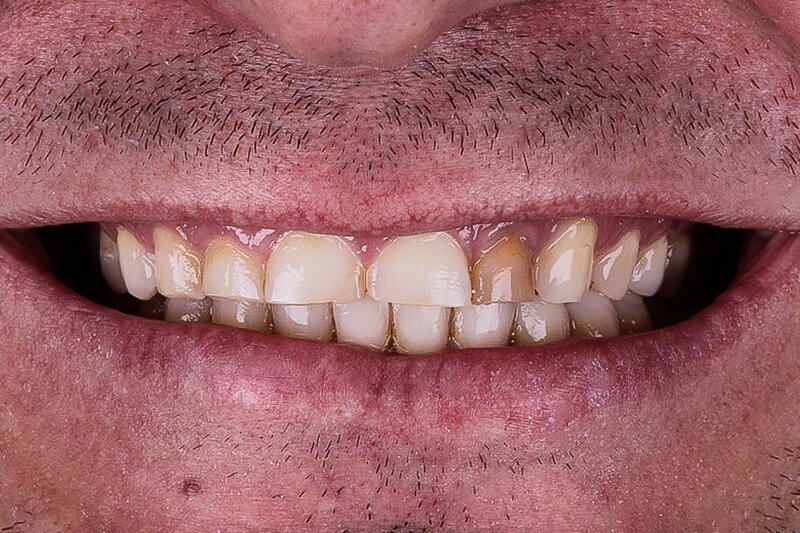 Read more about the article Desgaste dentário: causas, sintomas e tratamentos